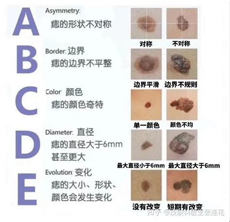 身體 痣|痣也可能会癌变！长在 3 个地方要注意